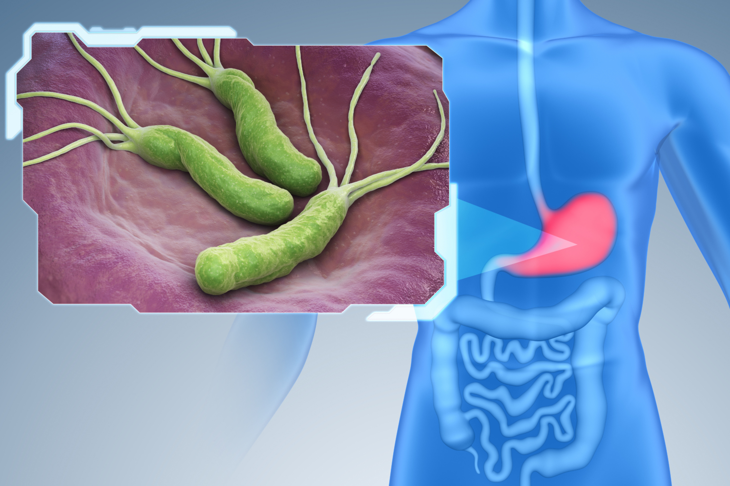 H. Pylori: a bactéria que pode levar ao câncer
