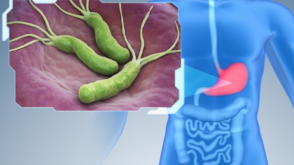 H. Pylori: a bactéria que pode levar ao câncer